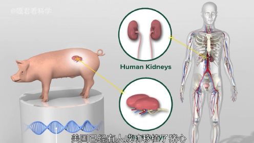 万能猪器官移植最新